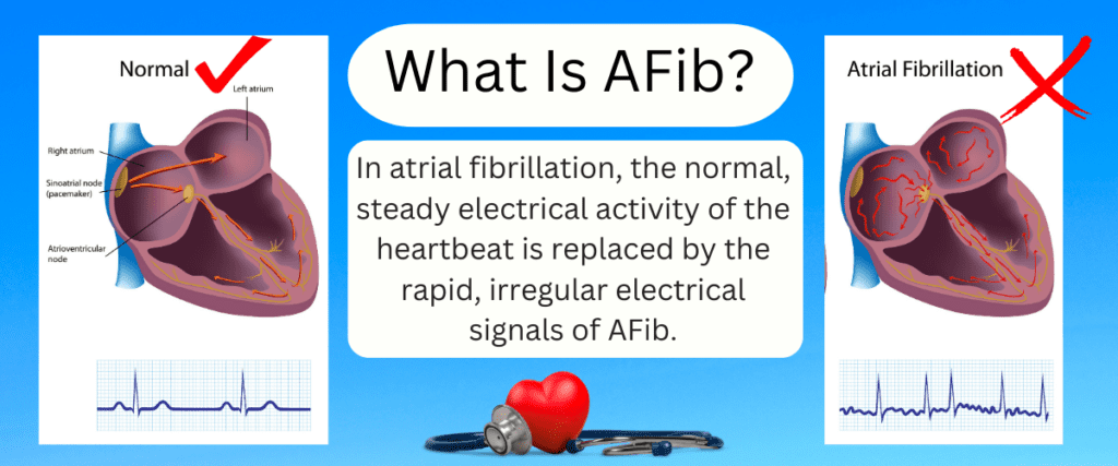 in afib the normal heart is replaced by a rapid irregular heart rhythm