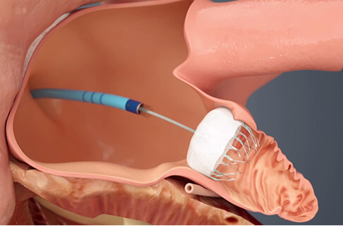 Reducing Stroke Risk: The Watchman Implant for AFib Patients